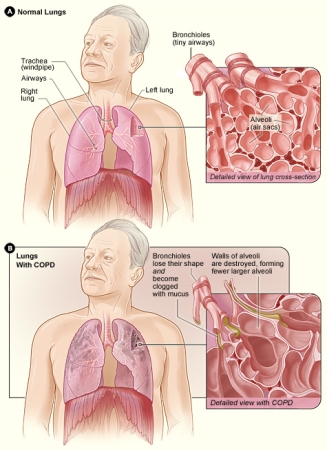 Person's lungs COPD