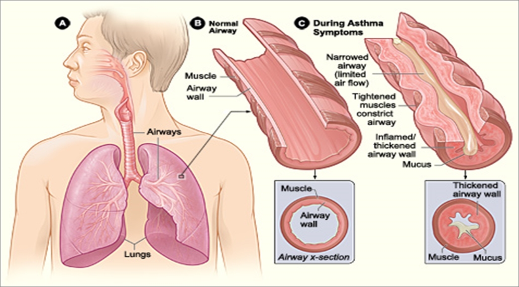 Asthma Diagram