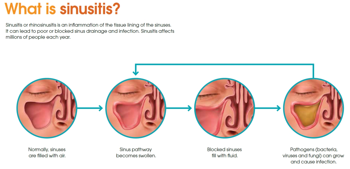 Natural Sinusitis Remedy Treatment Via Salt Cave Therapy